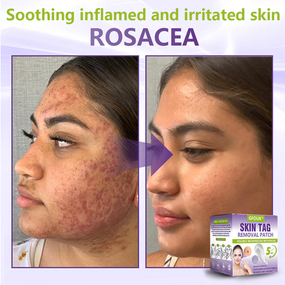 GFOUK® Soluble Microneedle Botanical Skin Tag Removal Patch🐞-up