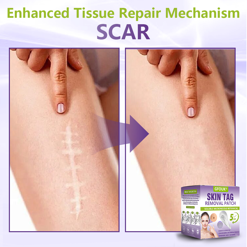 GFOUK® Soluble Microneedle Botanical Skin Tag Removal Patch🐞-up