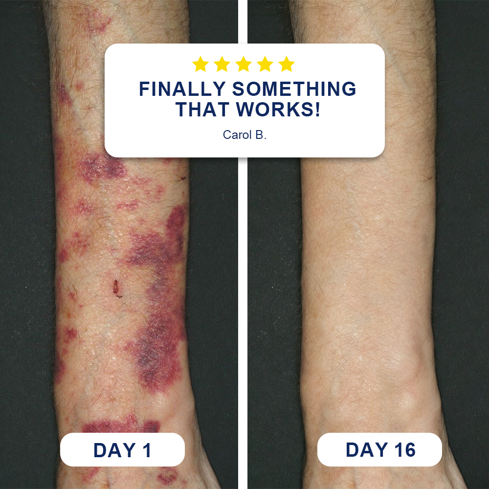💥120K+ SOLD💕- Evolvion® Bruise Repair & Skin-Strengthening Cream🍀