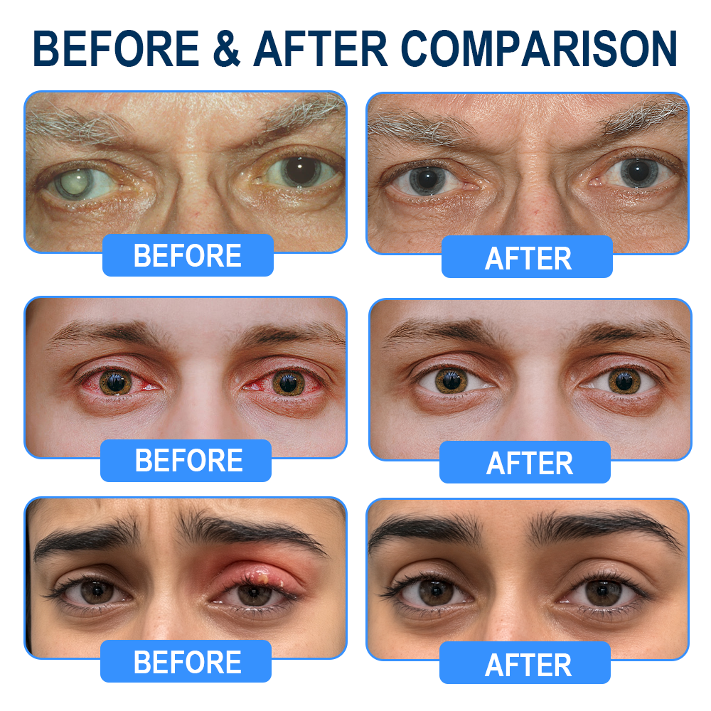 Rekulo® OptiMist Eye Spray✅For dry eyes, blurry vision, eye strain, presbyopia, and cataracts 👀👀