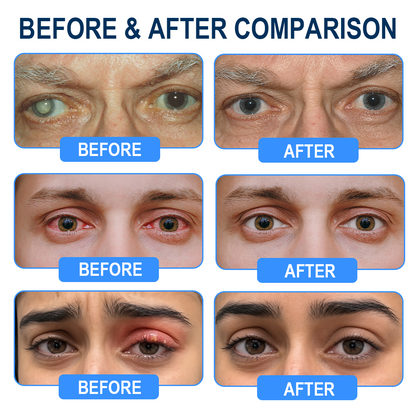 Rekulo® OptiMist Eye Spray✅For dry eyes, blurry vision, eye strain, presbyopia, and cataracts 👀👀