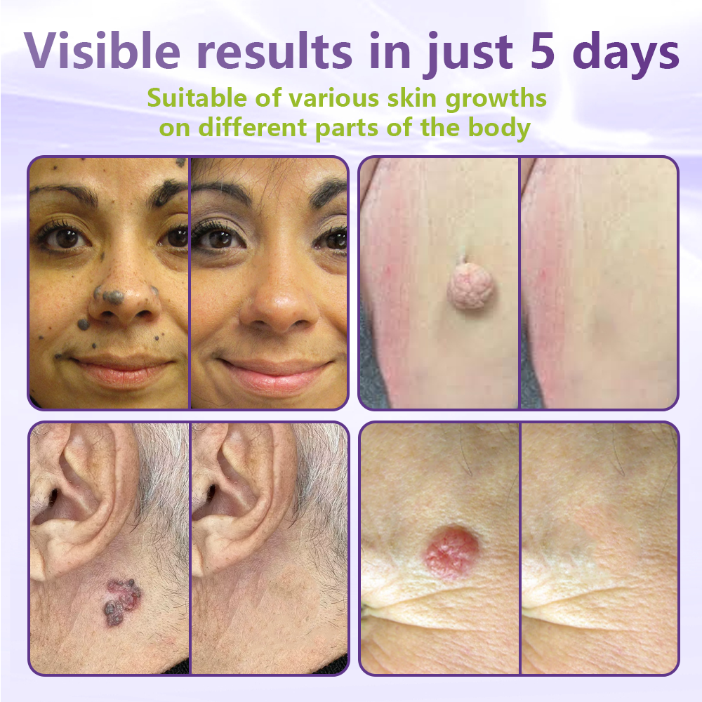 GFOUK® Soluble Microneedle Botanical Skin Tag Removal Patch🐞-up