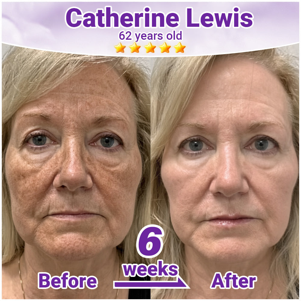 ✨Rolimey® Advanced Age Spot Correcting Serum✨✨