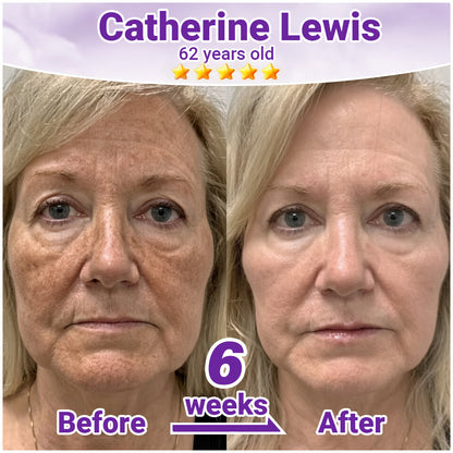 ✨Rolimey® Advanced Age Spot Correcting Serum✨✨