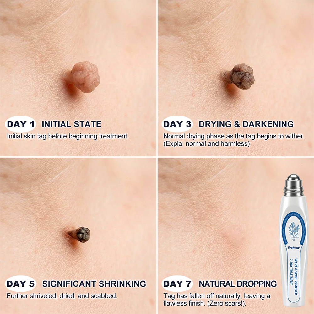 Made and Shipped from UK ✨Evolvion® 𝟕-𝐃𝒂𝘆 𝐒𝗸𝐢𝐧 𝐓𝒂𝗴 & 𝐒𝐩𝙤𝐭 𝐄𝐫𝒂𝐬𝙚𝐫 Painless & Scar-Free Advanced Imperfection Remova𝗜 Ro𝗜𝗜erba𝗜𝗜 Pen💫💫