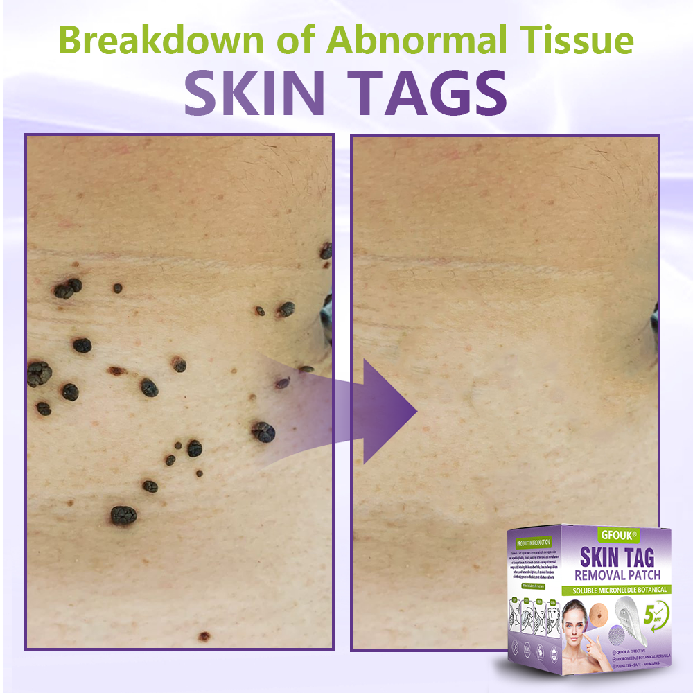 GFOUK® Soluble Microneedle Botanical Skin Tag Removal Patch🐞-up