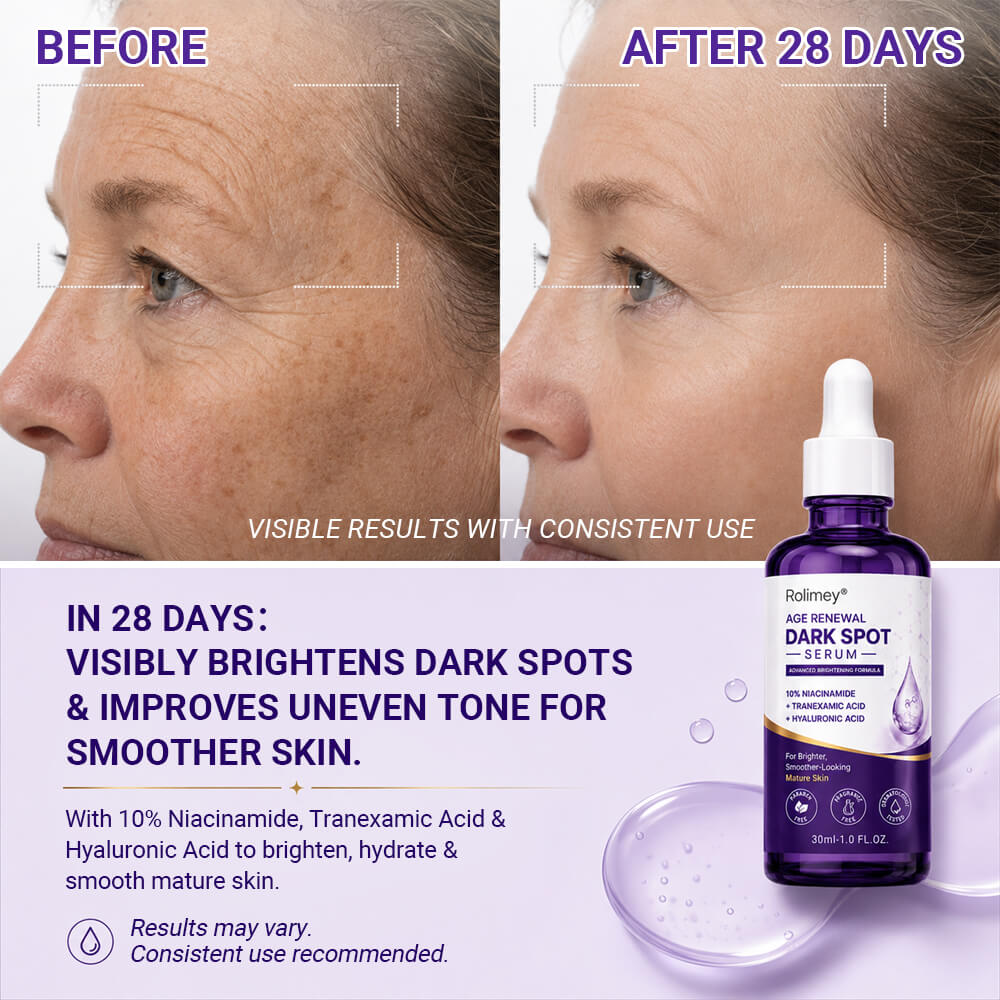 ✨ Rolimey® Age Renewal Dark Spot Serum — Infused with 10% Niacinamide, Tranexamic Acid & Hyaluronic Acid for Brighter, Smoother-Looking Mature Skin 🍀🍀