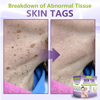 GFOUK® Soluble Microneedle Botanical Skin Tag Removal Patch🐞-up