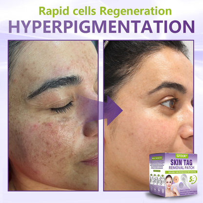 GFOUK® Soluble Microneedle Botanical Skin Tag Removal Patch🐞-up