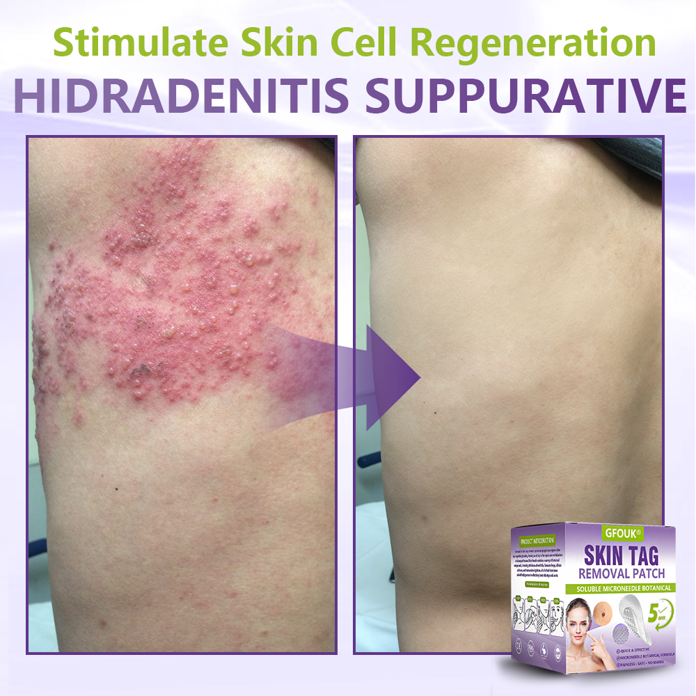 GFOUK® Soluble Microneedle Botanical Skin Tag Removal Patch🐞-up