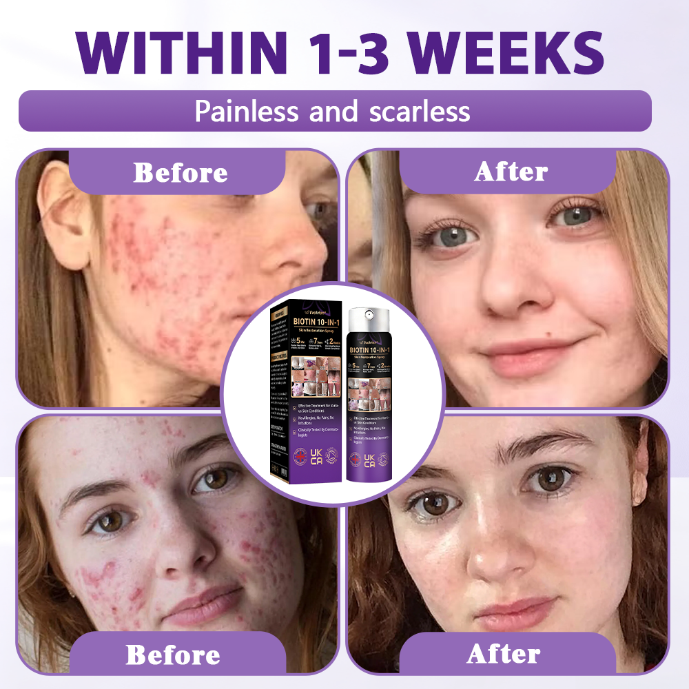 Made and shipped from the United Kingdom ✨Evolvion® Biotin 10-in-1 Skin Restoration Spray✨✨